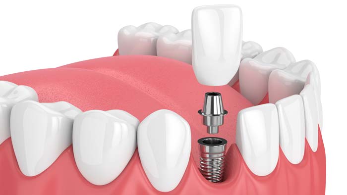 Dental Implants Ann Arbor