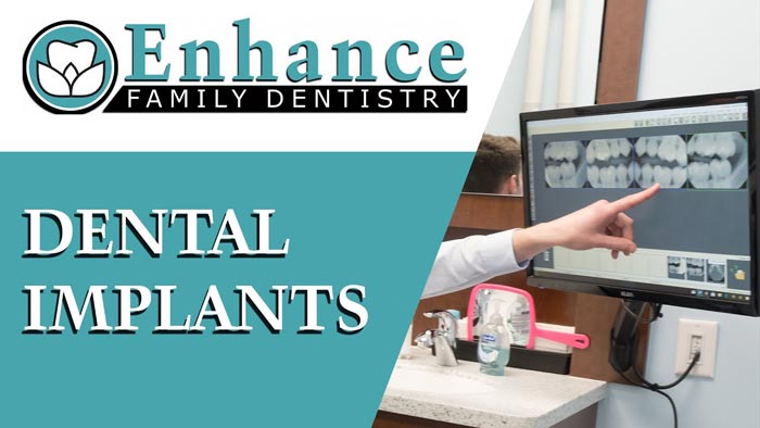 Dental Implant Dentists Ann Arbor Mi