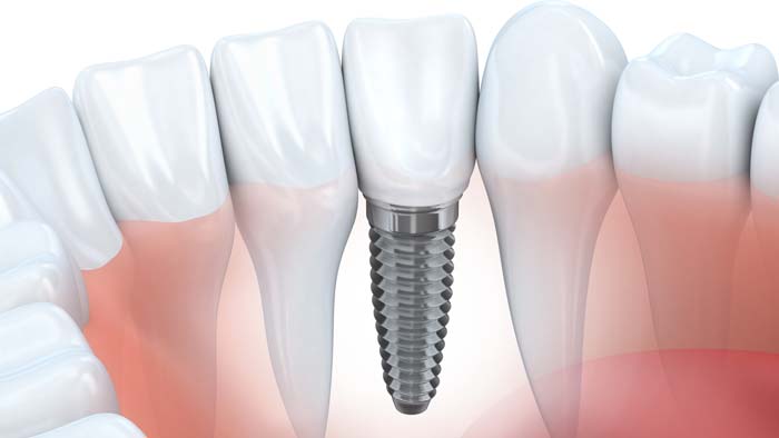 Dental Implant Dentists Near Ann Arbor Mi