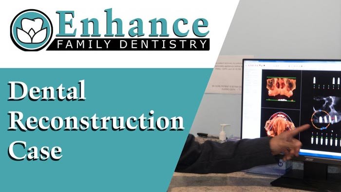 Dental Reconstruction Ann Arbor Mi Dentists